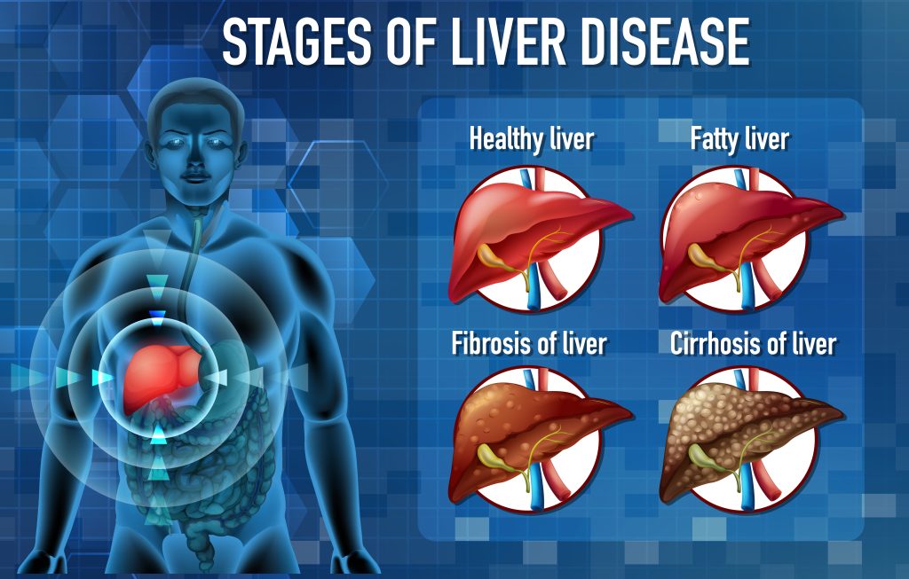 Stages of liver disease